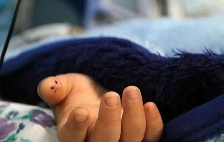 مرگ یک دختر بچه سه‌ساله بر اثر عقرب‌ گزیدگی