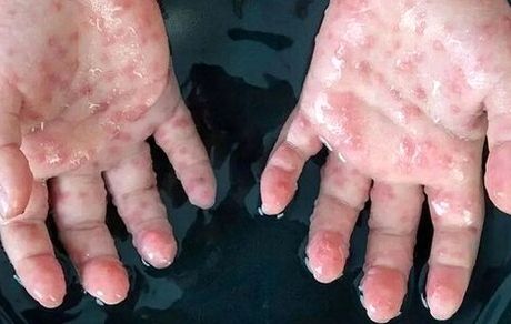 شناسایی ۳ مورد جدید مبتلایان به آبله میمون در امارات