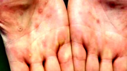 تولید کیت‌های تشخیص آبله میمونی در کشور/ هنوز الزامی برای تزریق واکسن آبله نیست