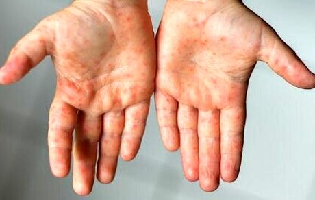 سرخک در کشور شیوع پیدا نکرده است/ ایمنی ۹۵ درصد مردم در برابر سرخک