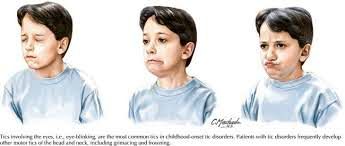 تیک های عصبی درمان دارند!