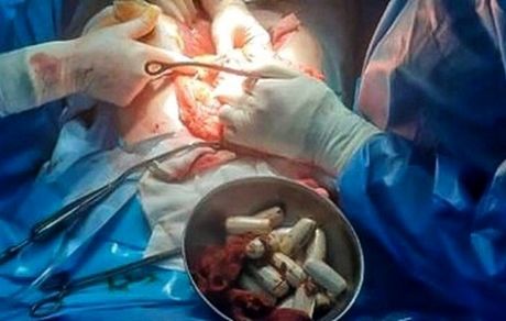 ۱۰۰ بسته مواد مخدر جاسازی شده از بدن یک جوان ۲۲ ساله خارج شد