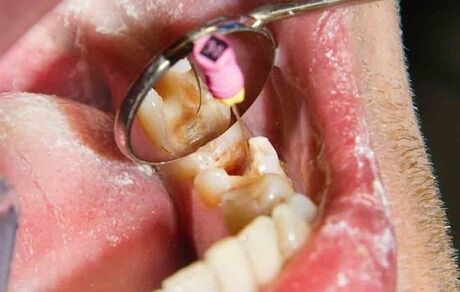 آغاز ارائه خدمات عصب‌کشی با تعرفه دولتی