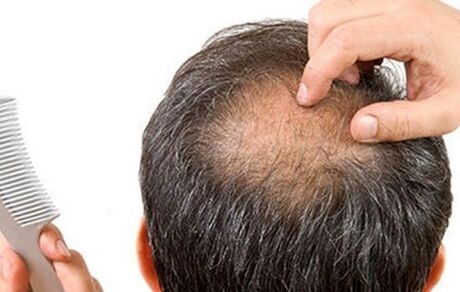 ریزش مو و چند دستورالعمل خانگی