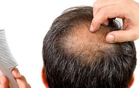 ریزش مو و چند دستورالعمل خانگی