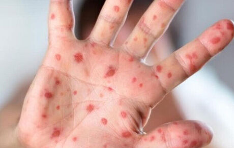 شیوع بیماری سرخک در استان فارس